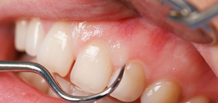 Periodontia (Gengiva)